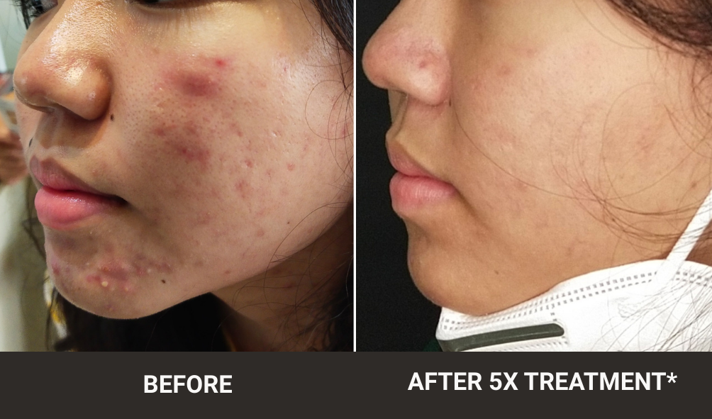 BEFORE-AFTER ACNE