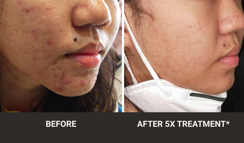 BEFORE-AFTER-ACNE