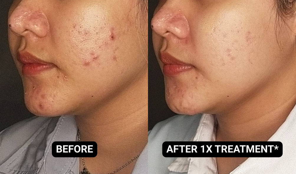 BEFORE-AFTER ACNE