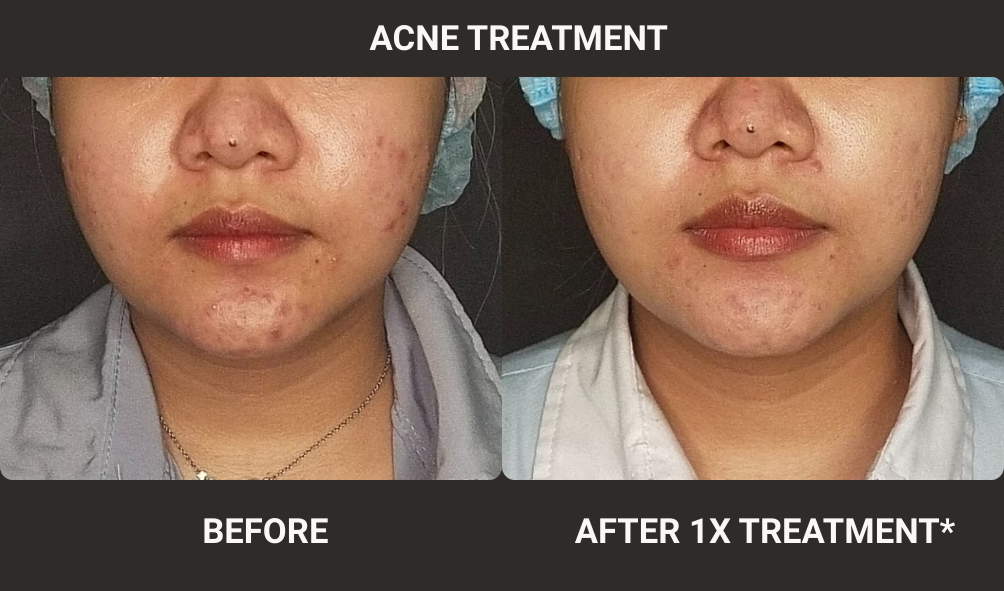 BEFORE-AFTER ACNE
