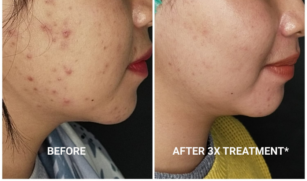 BEFORE-AFTER ACNE 3