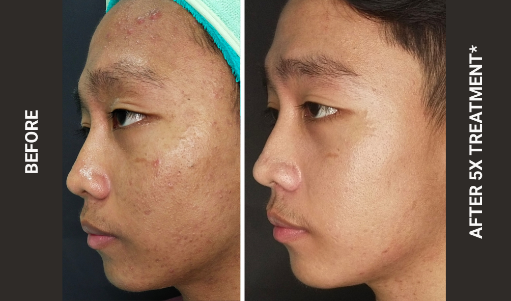 BEFORE - AFTER ACNE 6