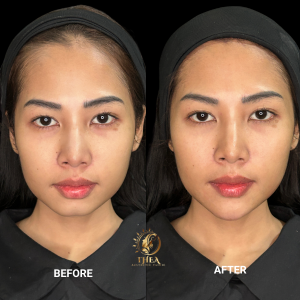 BEFORE - AFTER FILLER DAGU