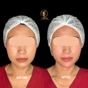 BEFORE - AFTER FILLER DAGU