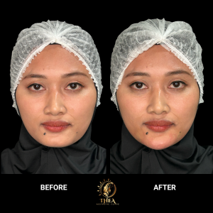 BEFORE - AFTER FILLER DAGU