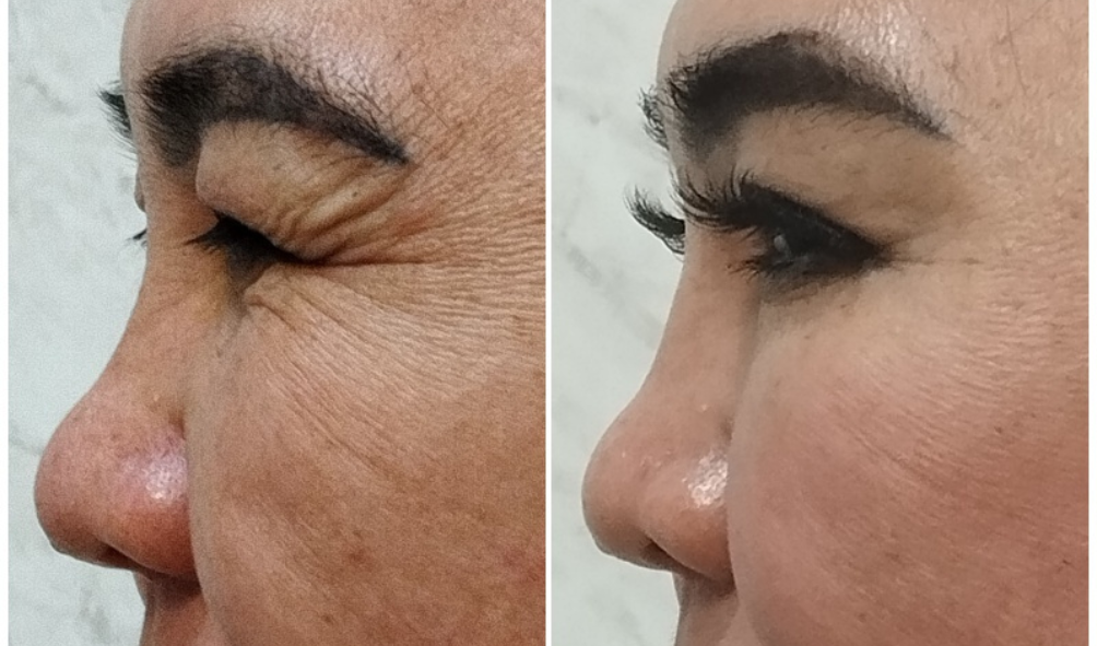 BEFORE-AFTER BOTOX SUDUT MATA