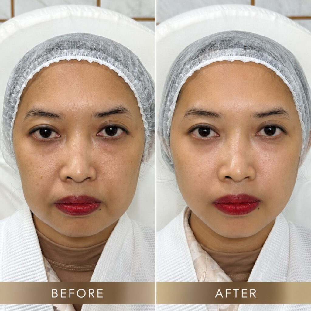 hasil-before-after-pembentukan-kontur-wajah- natural- vshape-klinik-thea